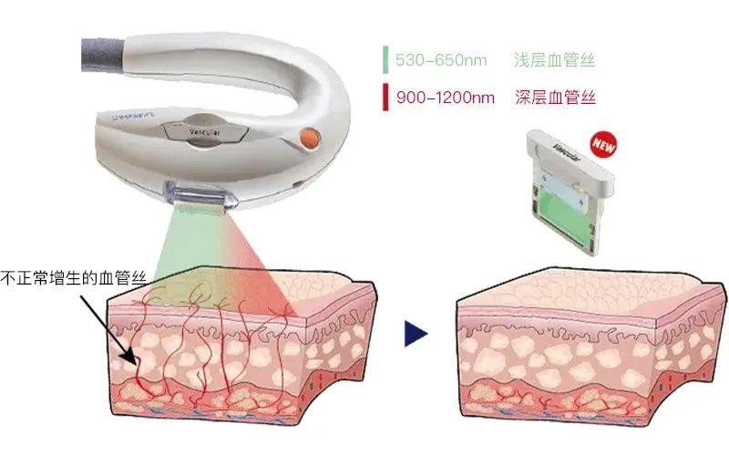 Vascular血管濾光片作用