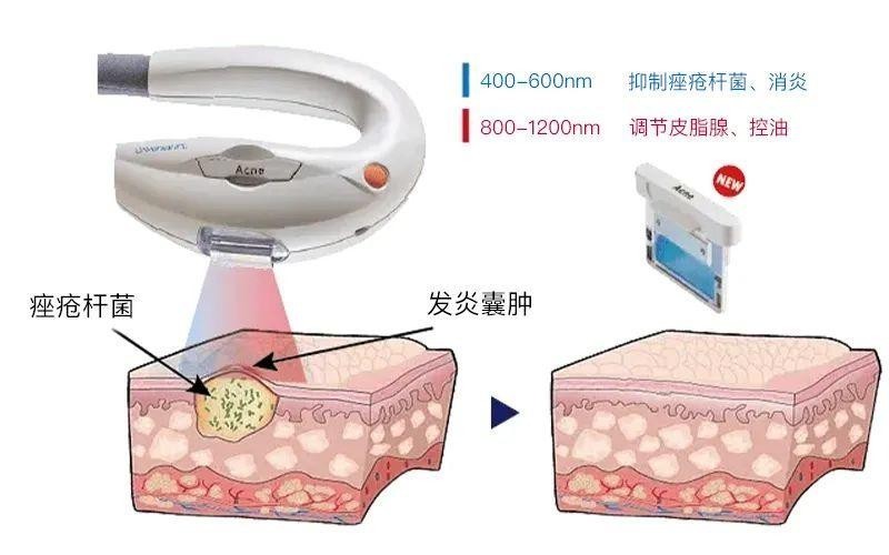 超光子中的痤瘡濾光片作用皮膚